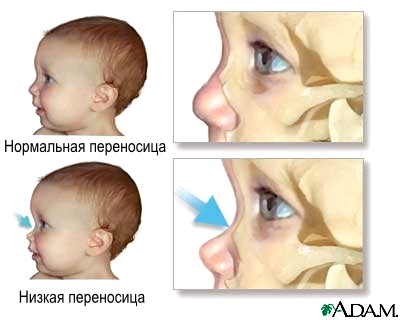FAS low nasal bridge.jpg