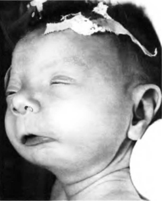 FAS low nasal bridge2.jpg