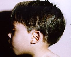 По данным Jon M. Aase, MD клиническая ассоциация педиатров Нью-Мексико[18]