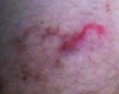 Cutaneous larva migrans 1.jpg