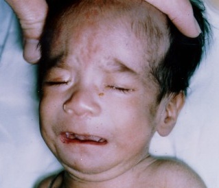 FAS low nasal bridge3.jpg