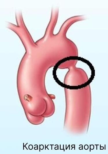 Коарктация.jpg